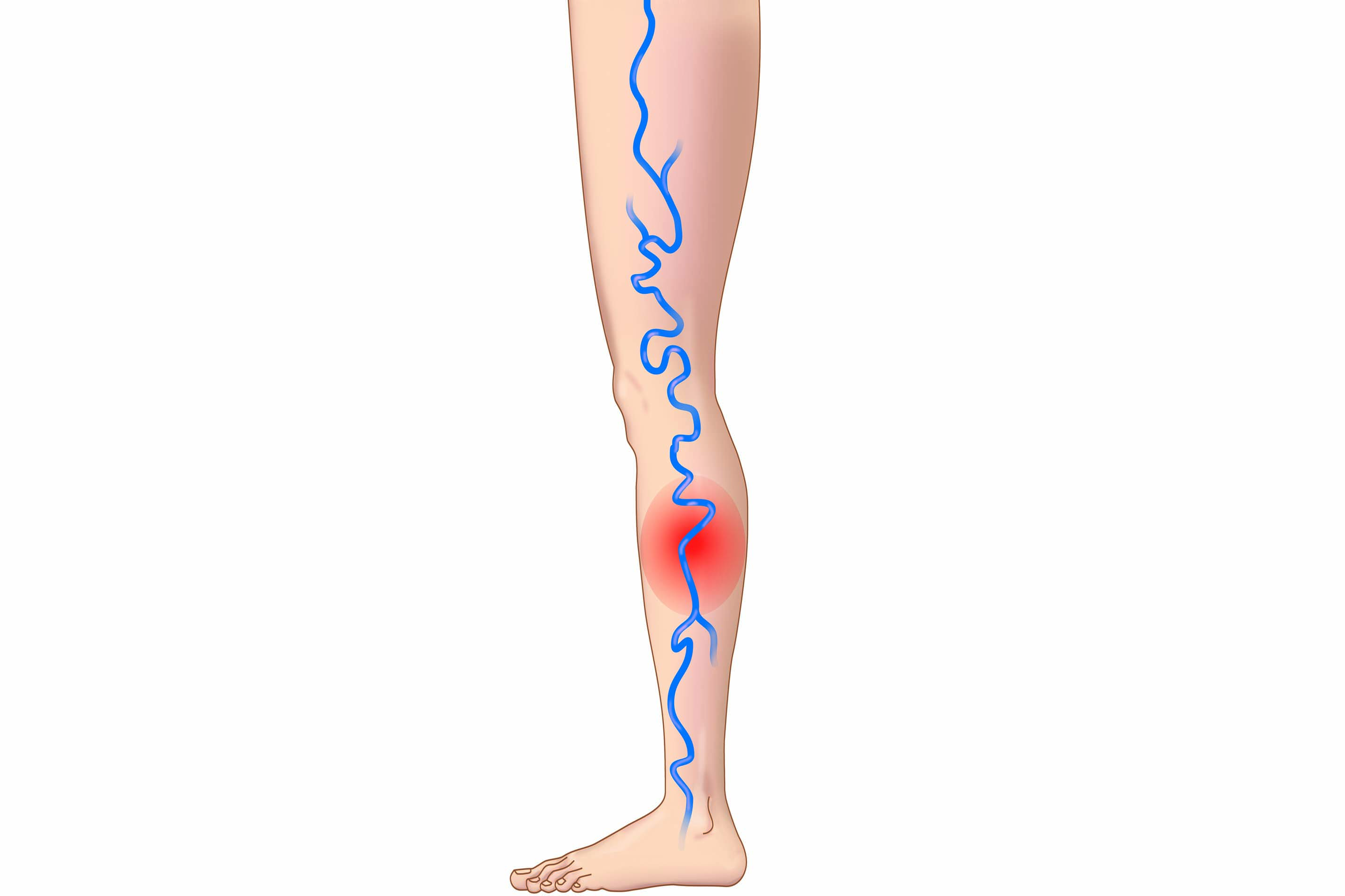 🎵 tiefe venenthrombose untersuchung tiefe venenthrombose therapie Domykinsdy