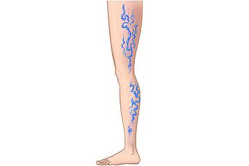 Krampfadern behandeln Klinik Vincentinum