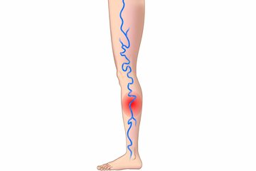 Venenthrombose behandeln in der Klinik Vincentinum